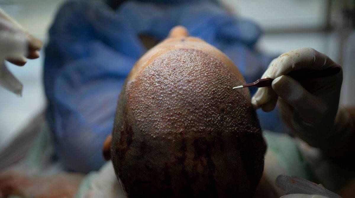 Turkey's Hair Transplant Industry and Its Medical Innovation
